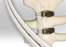 Pic_supercable_sternotomy_closure